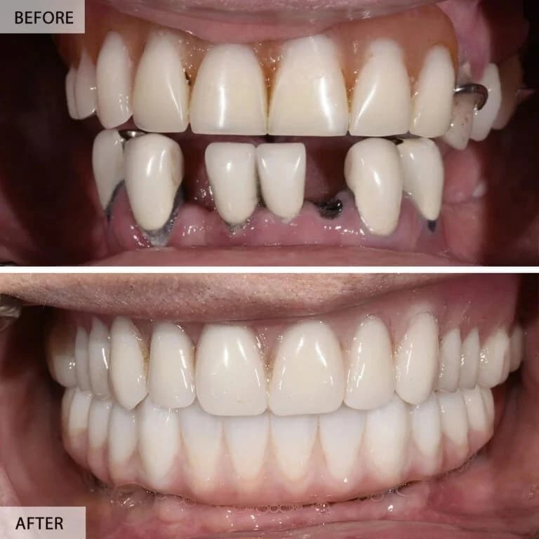 Teeth Whitening