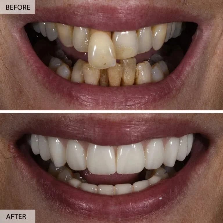 Dental Veneers