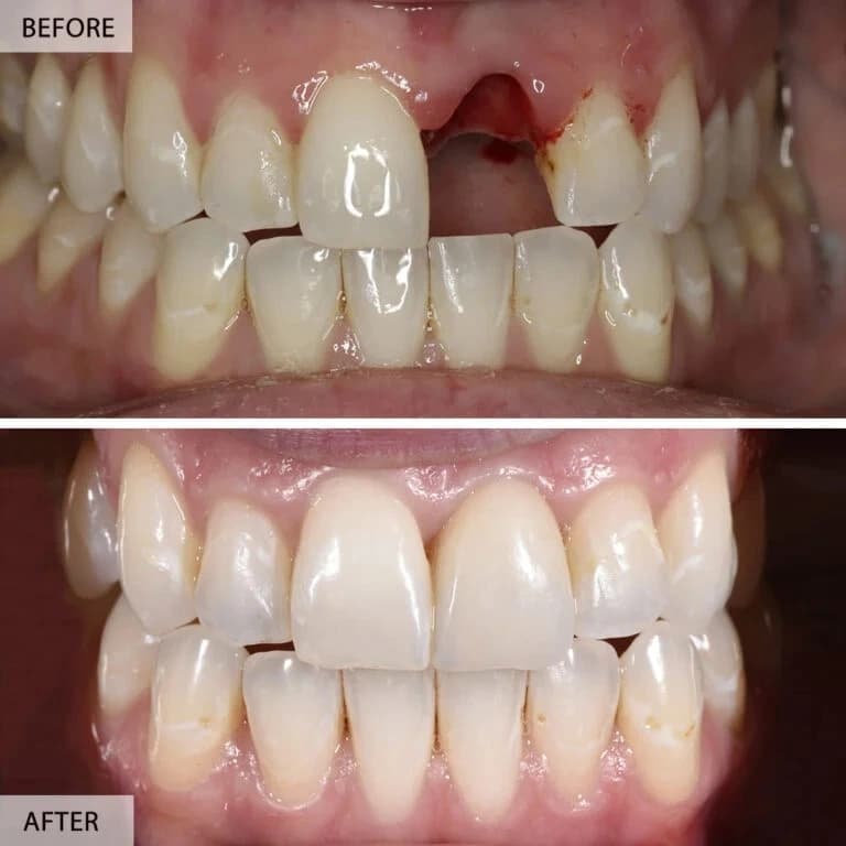 Smile Makeover