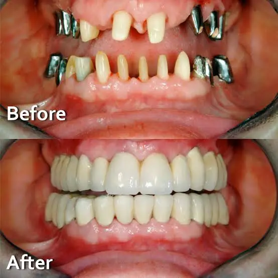 Dental Implants
