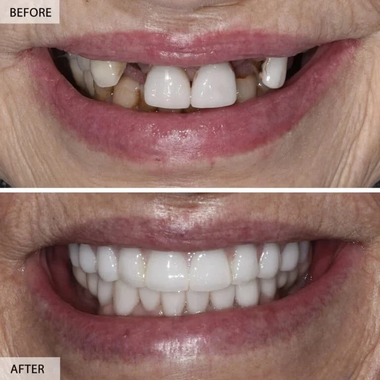 Orthodontic Treatment