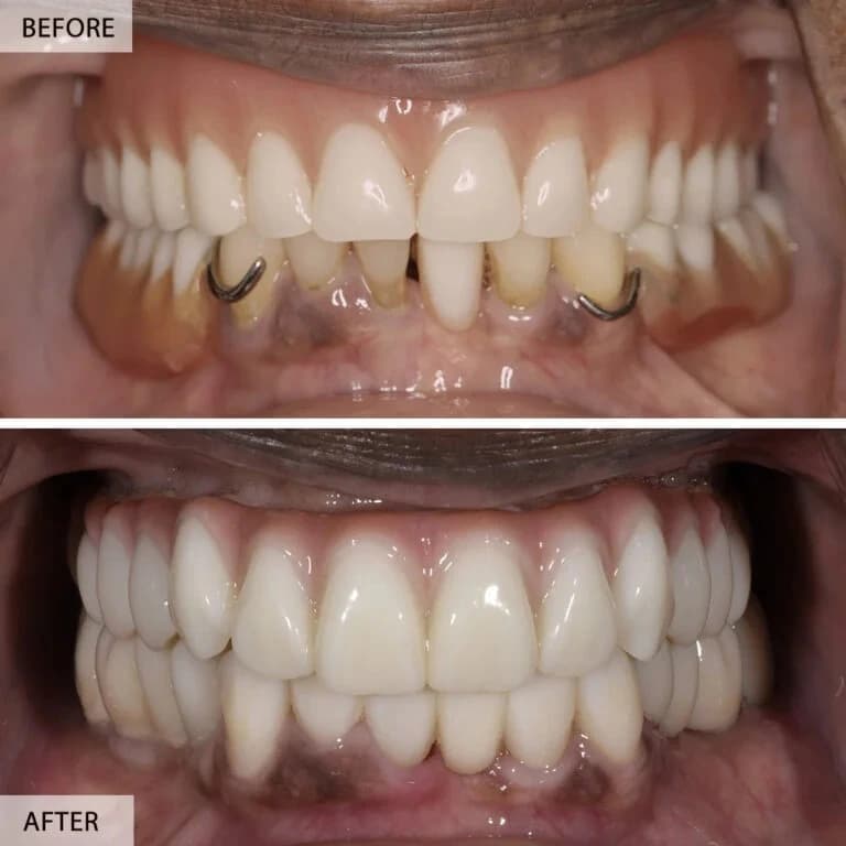 Composite Bonding