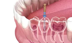 Root Canal