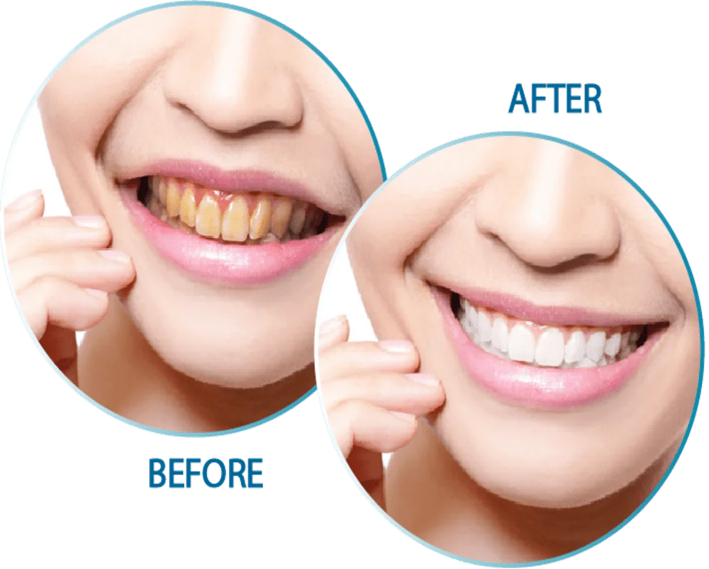 Teeth Whitening